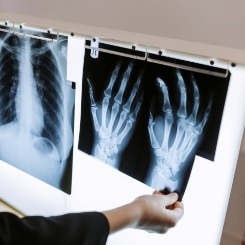 X-ray chart