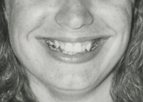 a black and white image of a persons smile from the nose under to the chin up.
