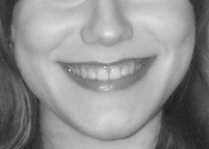 a black and white image of a persons smile with teeth showing. The photo shows the face from the nose under to the chin up.